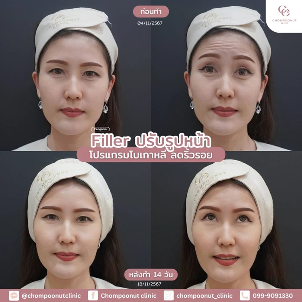 Review โปรแกรมฟิลเลอร์ 3