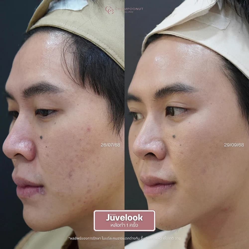 Review โปรแกรม Juvelook 4