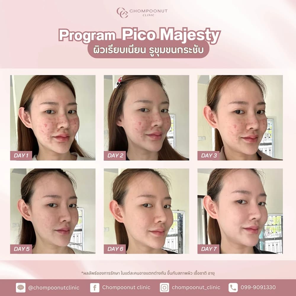 Review โปรแกรม Pico 4