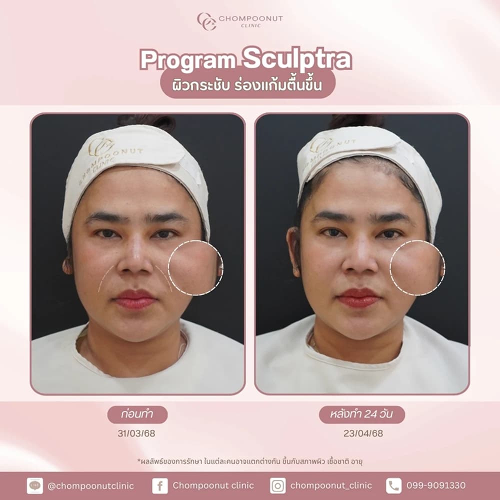 Review โปรแกรม Sculptra 3