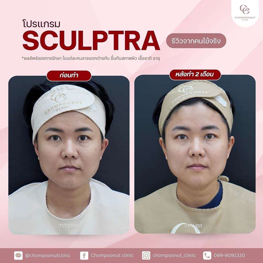 Review โปรแกรม Sculptra 4