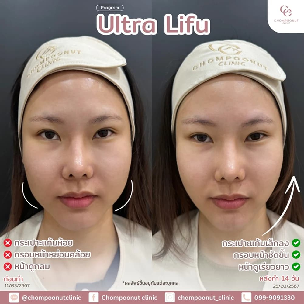 Review โปรแกรม Ultra Lifu 3