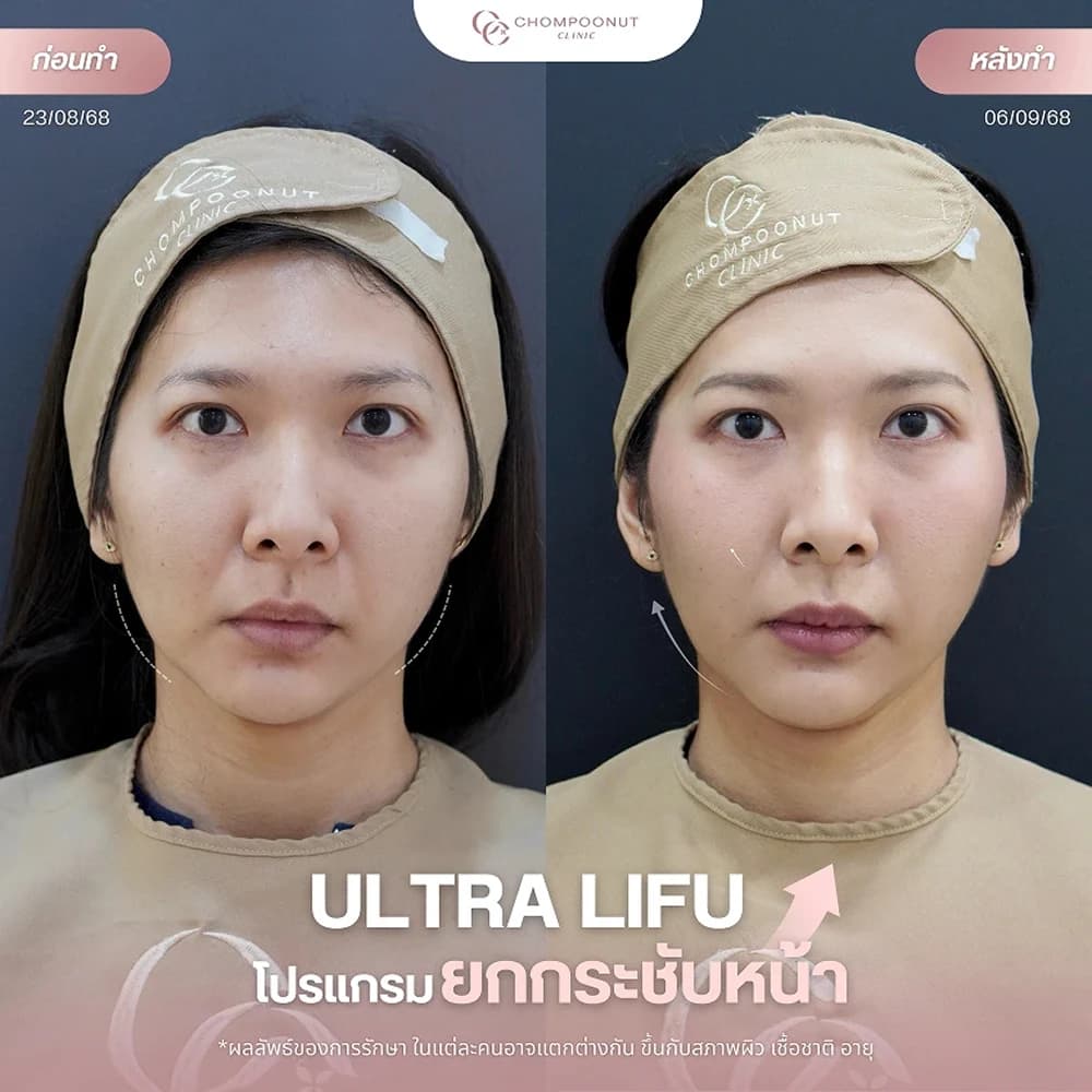 Review โปรแกรม Ultra Lifu 4