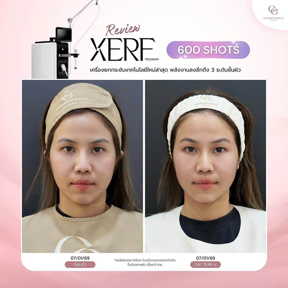 Review โปรแกรม XERF 3